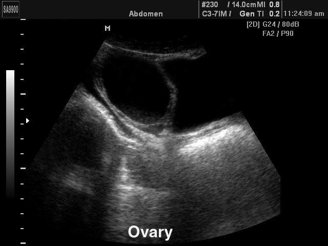 Ovary, B-mode (echogramm №196)