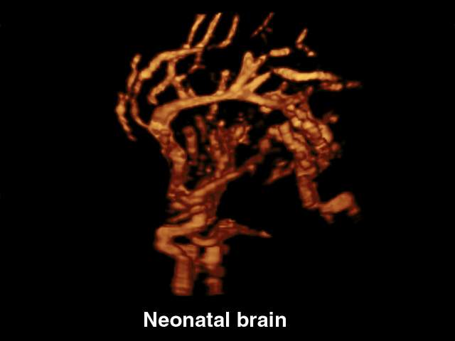 Neonatal brain, power doppler & 3D (echogramm №212)