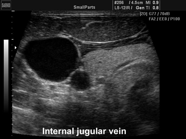Internal jugular vein, B-mode (echogramm №217)