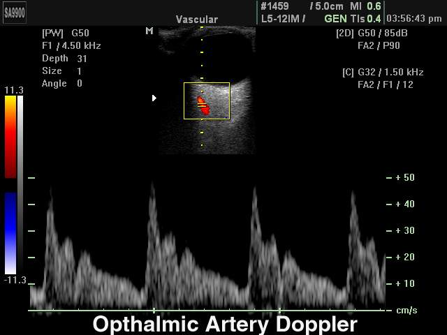 Opthalmic artery, CFM & PW (echogramm №227)