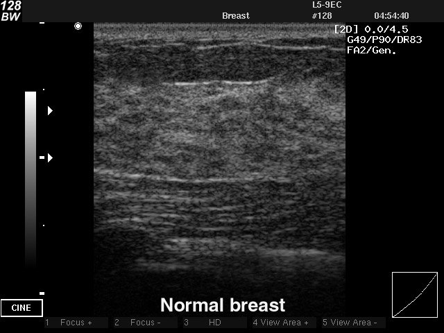 Breast  - norm, B-mode (echogramm №24)