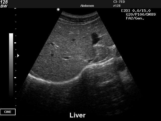 Liver, B-mode (echogramm №25)
