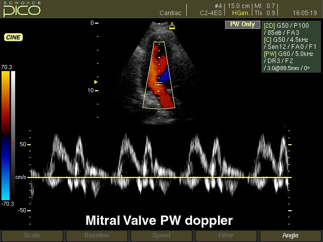 Mitral valve, CFM & PW (echogramm №251)