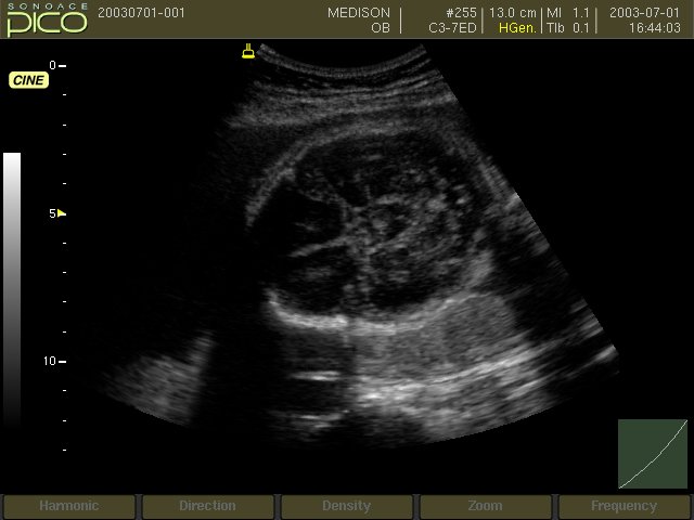 Fetal head, B-mode (echogramm №253)