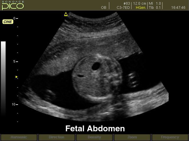 Fetal abdomen, B-mode (echogramm №255)