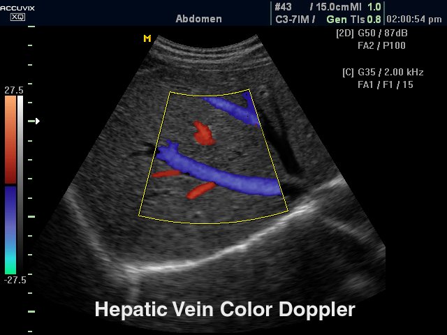 Hepatic vein, color doppler (echogramm №290)