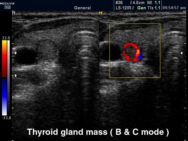 Thyroid nodule, B-mode & CFM (echogramm №323)