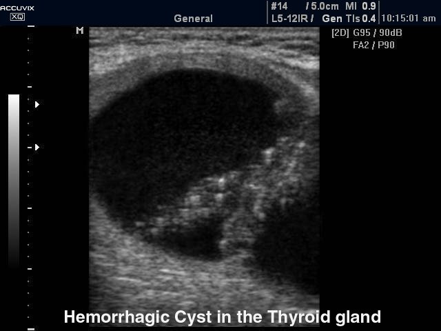 Thyroid - hemorrhagic cyst, B-mode (echogramm №331)