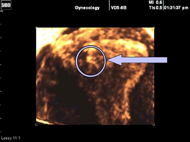 Fetus - 22 days, 3D (echogramm №355)