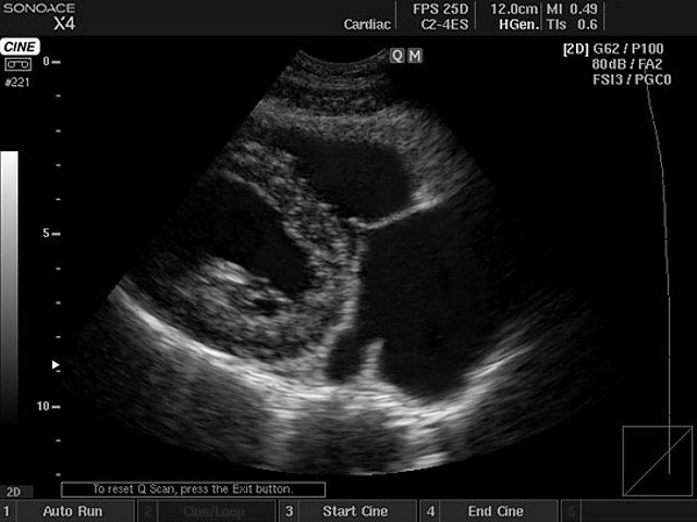 Heart - right ventricular inflow, B-mode (echogramm №409)