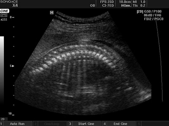 Fetus - spine, B-mode (echogramm №414)