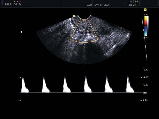 Uterus, CFM & PW (echogramm №468)