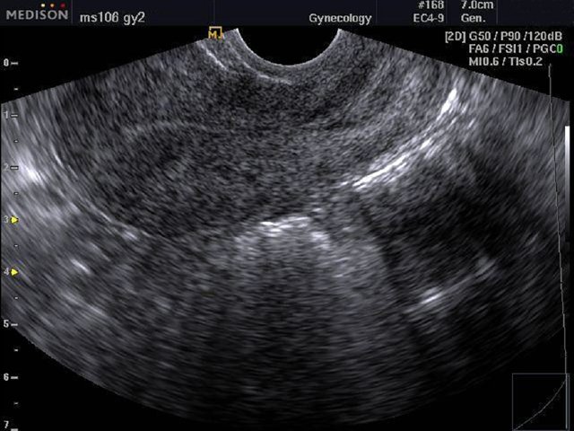 Uterus, B-mode (echogramm №481)