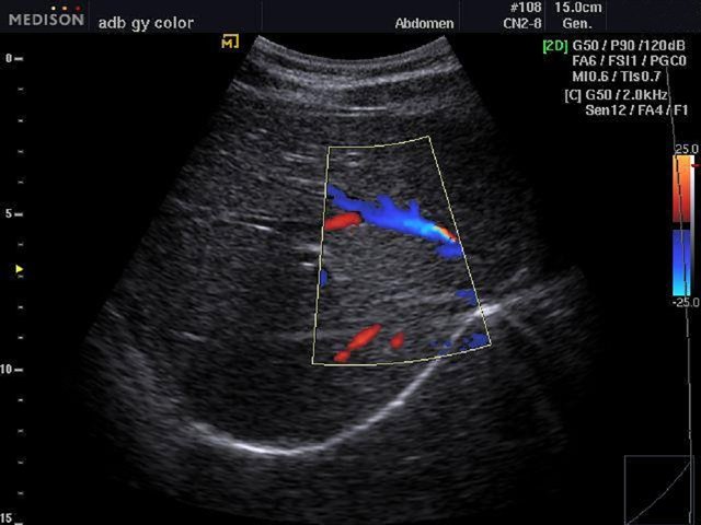 Liver blood flow, color doppler (echogramm №483)