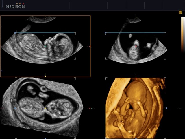 Fetus - 13 weeks, MPR, HDVI (echogramm №512)