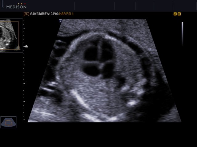 Fetal heart (4 chamber view), B-mode (echogramm №521)