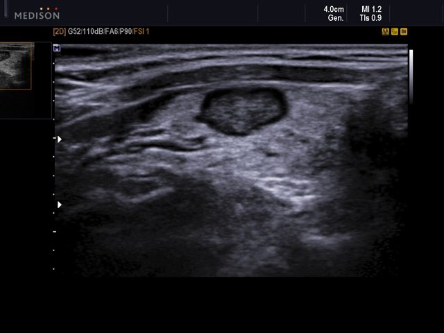 Thyroid benign nodule, B-mode (echogramm №545)