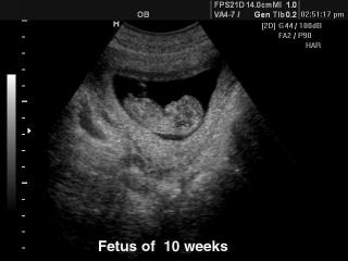 Fetus  - 10 weeks, B-mode