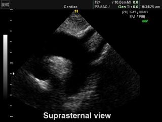 Heart (suprasternal view), B-mode