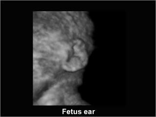 Fetal ear, B-mode