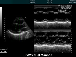 Left ventricle and mitral valve, M-mode