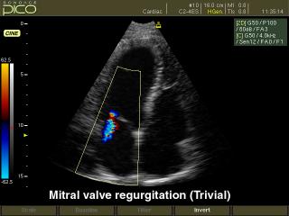 Mitral valve regurgitation, color doppler