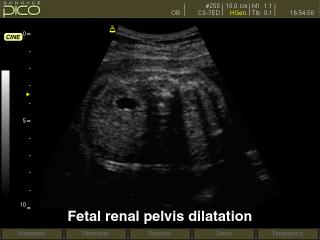 Fetal renal pelvis dilatation, B-mode