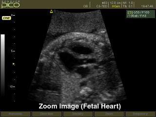 Fetal heart, B-mode