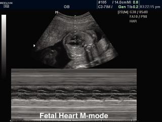 Fetal heart, M-mode