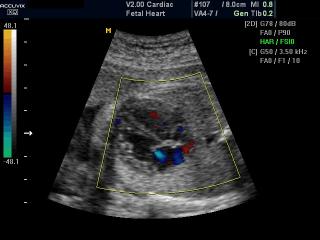 Fetal heart, color doppler