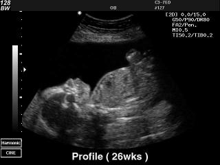 Fetus - 26 weeks, B-mode