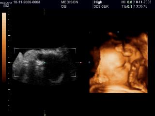 Fetal face and umbilical cord, 3D