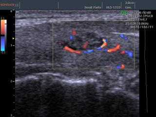 Thyroid nodule, color doppler