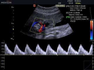 Fetus - umbilical artery, CFM & PW