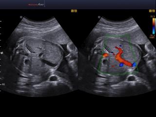 Fetus, abdomen, B-mode & CFM