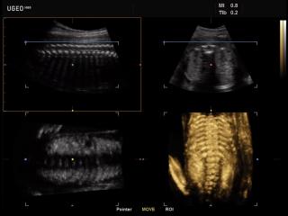 Fetal spine, MPR & 3D