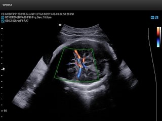 Fetus - middle cerebral artery, S-Flow
