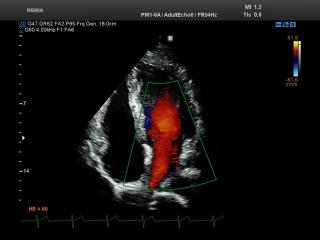 Heart (apical 4 chamber view), color doppler
