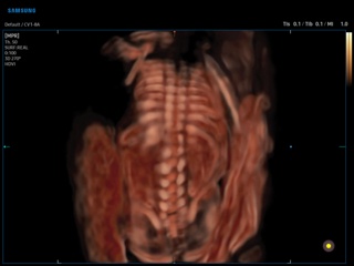 Fetal spine, CrystalVue, 3D
