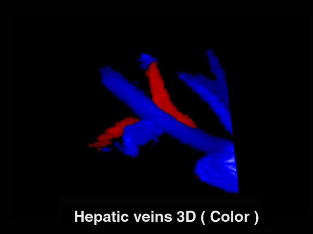 Печеночные вены, цветной допплер, 3D (эхограмма №168)