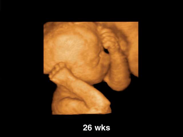3 D Ultrasound. Fetal, 26 weeks, 3D