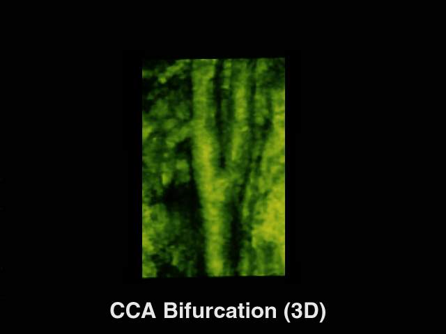 Бифуркация общей сонной артерии, 3D (эхограмма №229)