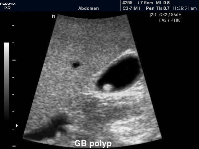 Papilloma in gallbladder - Hpv and gallbladder - Papilloma of the gallbladder