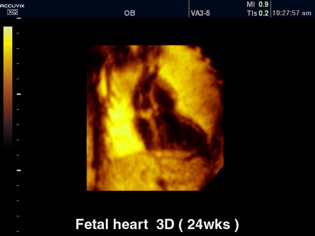Сердце плода - 24 недели, 3D (эхограмма №315)