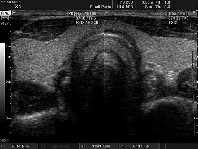 Щитовидная железа, B-режим (эхограмма №415)