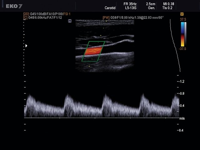 Внутренняя сонная артерия, CFM и PW (эхограмма №492)