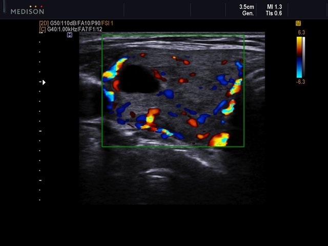 Щитовидная железа - коллоидные узлы, ЦДК (эхограмма №544)