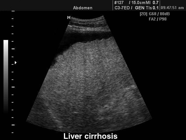 [RU] Ultrasound image description. Liver cirrhosis.