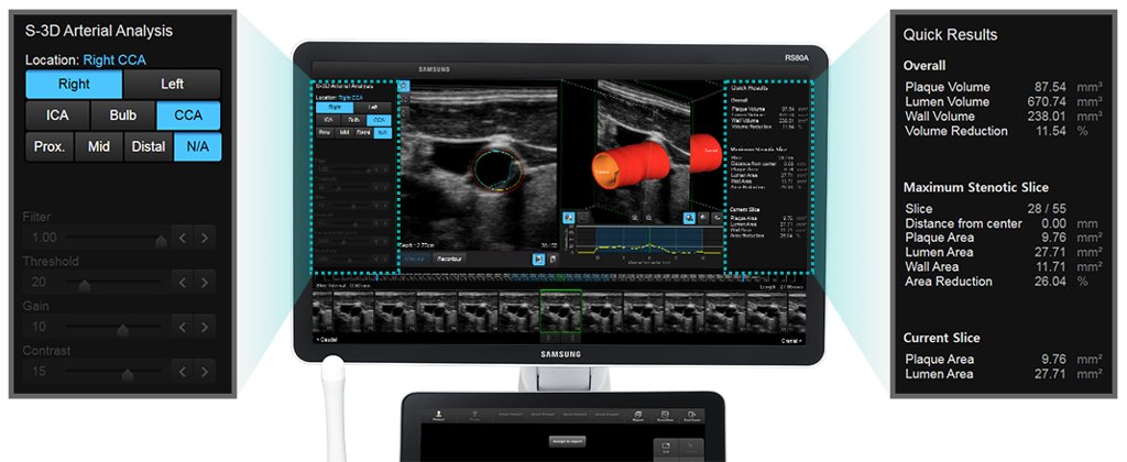 S-3D Arterial Analysis - оценка состояния сосудов на RS80A