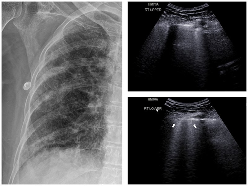 Рентгенография и УЗИ пациентки 75 лет с пневмонией и подтвержденным диагнозом COVID-19 (a)